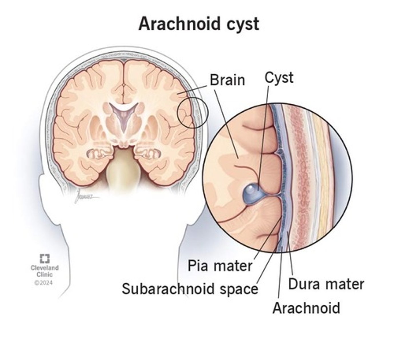 <p>- abnormale ontdubbeling arach vliezen</p><p>- tijdens verandering matrix -> CSv (tussen Pia en arach)</p>
