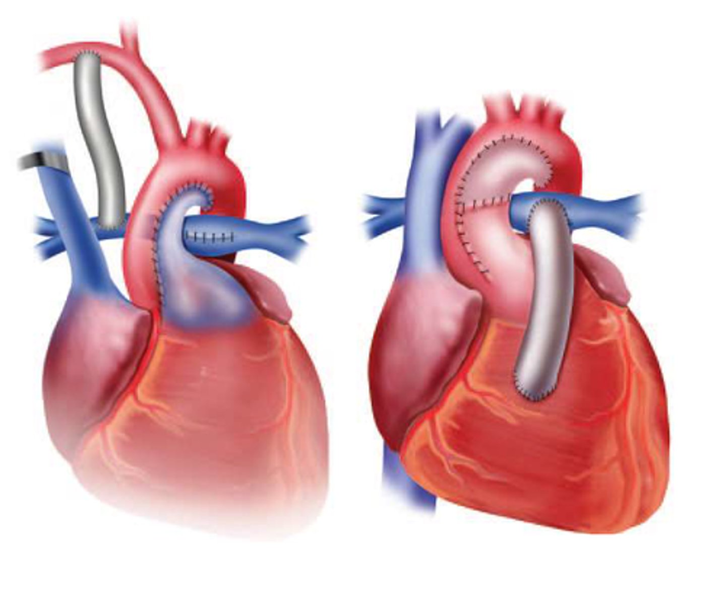 <p>aortopulmonary amalgamation (unification)</p>