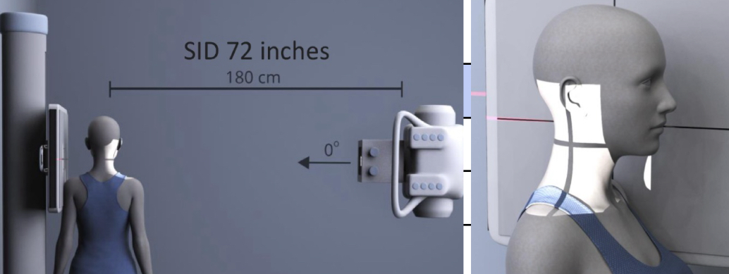 <p>SID: 72”</p><p>Air Gap: YES</p><p>Cassette Size: 10×12</p><p>Collimation: superior to C1, inferior to T1</p><p>Tube tilt: N/A</p><p>Measure through: C7 level</p><p>Central ray: C4 (thyroid)</p><p style="text-align: left">Breathing: suspend EXPIRATION</p>