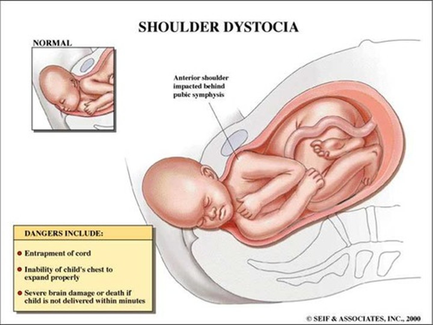 <p>An obstetric emergency in which the anterior shoulder of the fetus becomes impacted behind the maternal pubic symphysis during vaginal delivery, or, less commonly, the posterior shoulder becomes impacted against the sacral promontory</p>