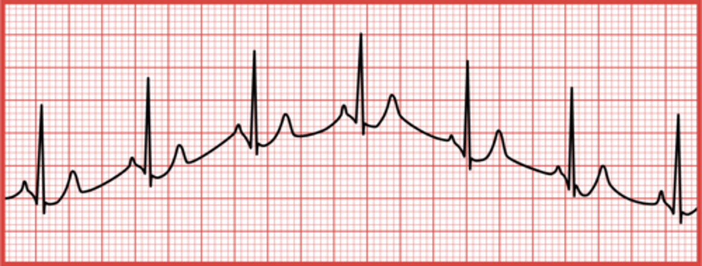 <p>Slight movement of the patient during the tracing or poor electrode attachment.</p>