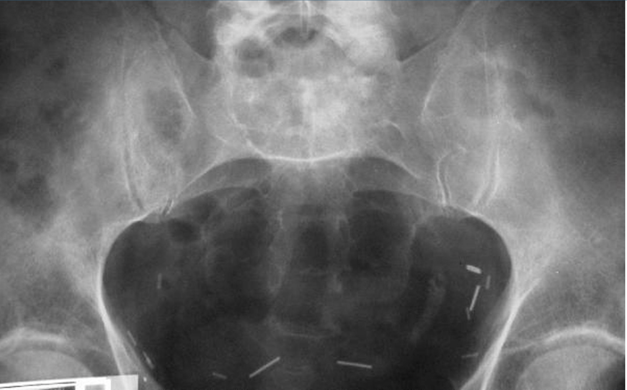 <p>KUB of Patient with ESWL last wee, what do you see?</p>