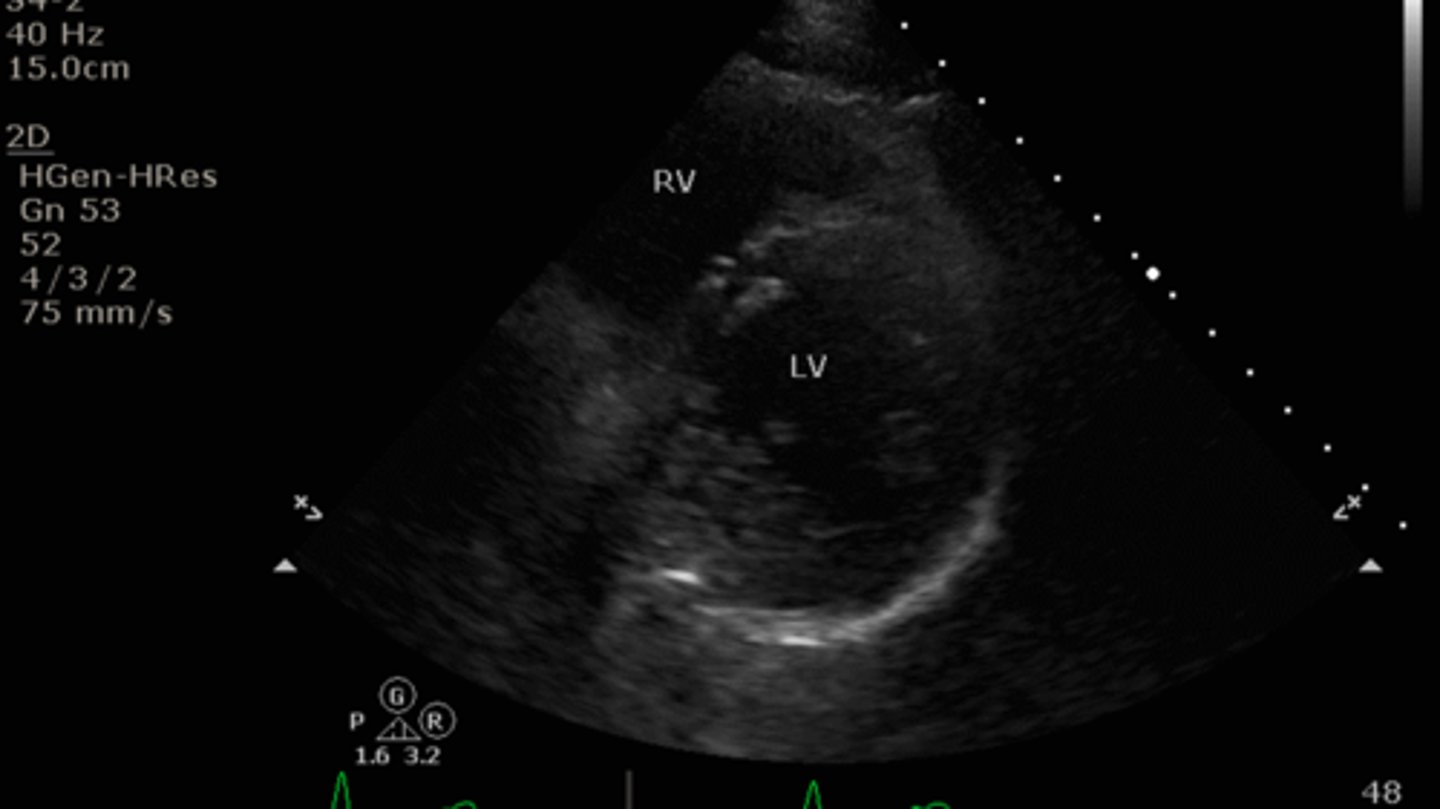 <p>LV, RV, IS, papillary muscles</p>