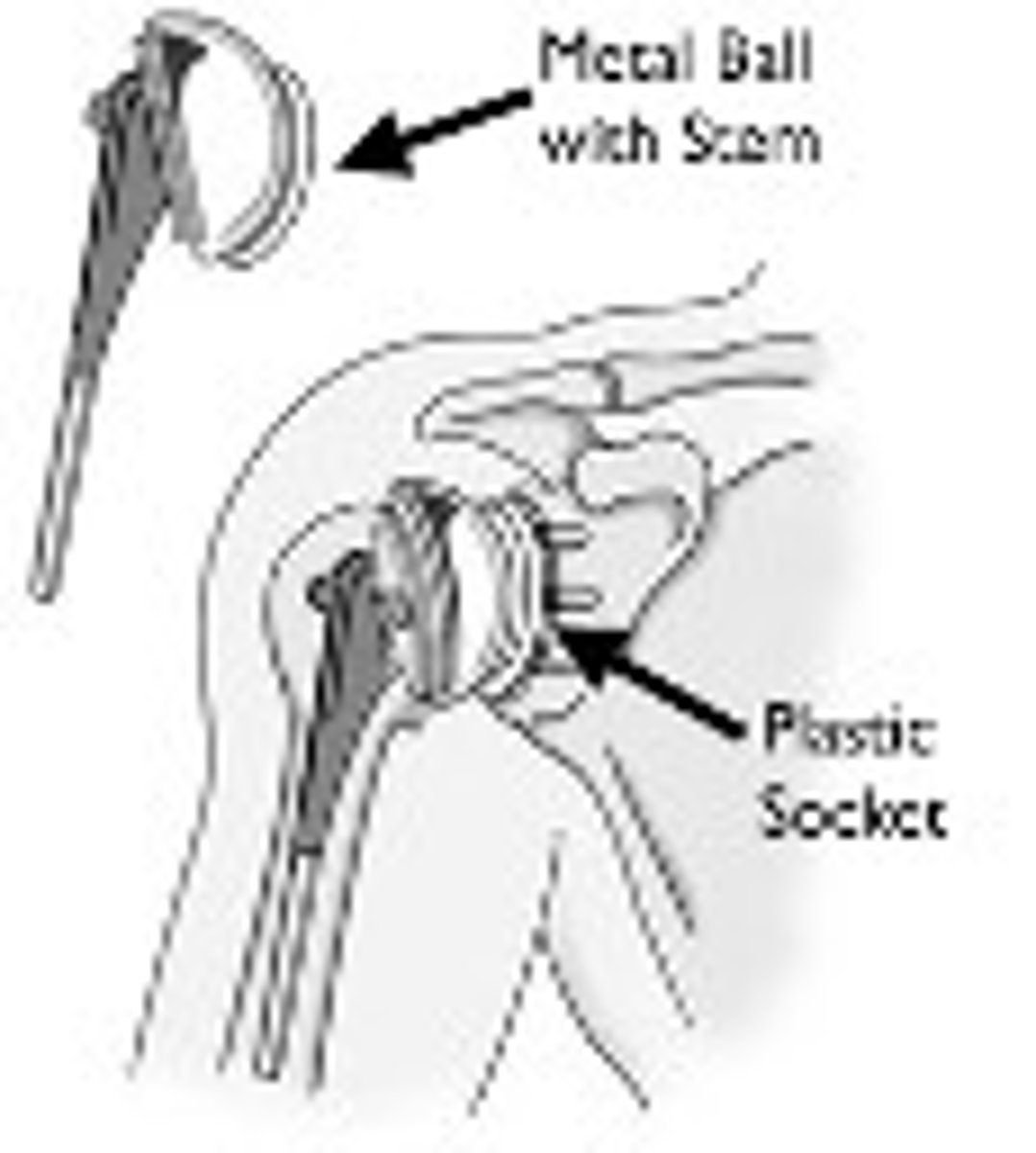 <p>-OT<br>-Rheumatoid Arthritis<br>-Trauma or severe injury<br>-Rotator cuff Injury<br>-Loss of ROM or overall weakness</p>