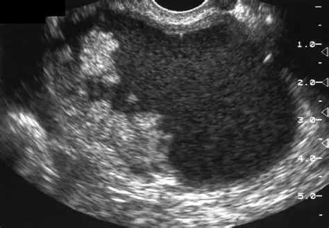 <p>Papillary Projection</p>
