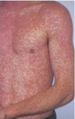 <p>CIRCUMSCRIBED, SOLIED ELEVATION OF SKIN. LESS THAN 1CM</p>