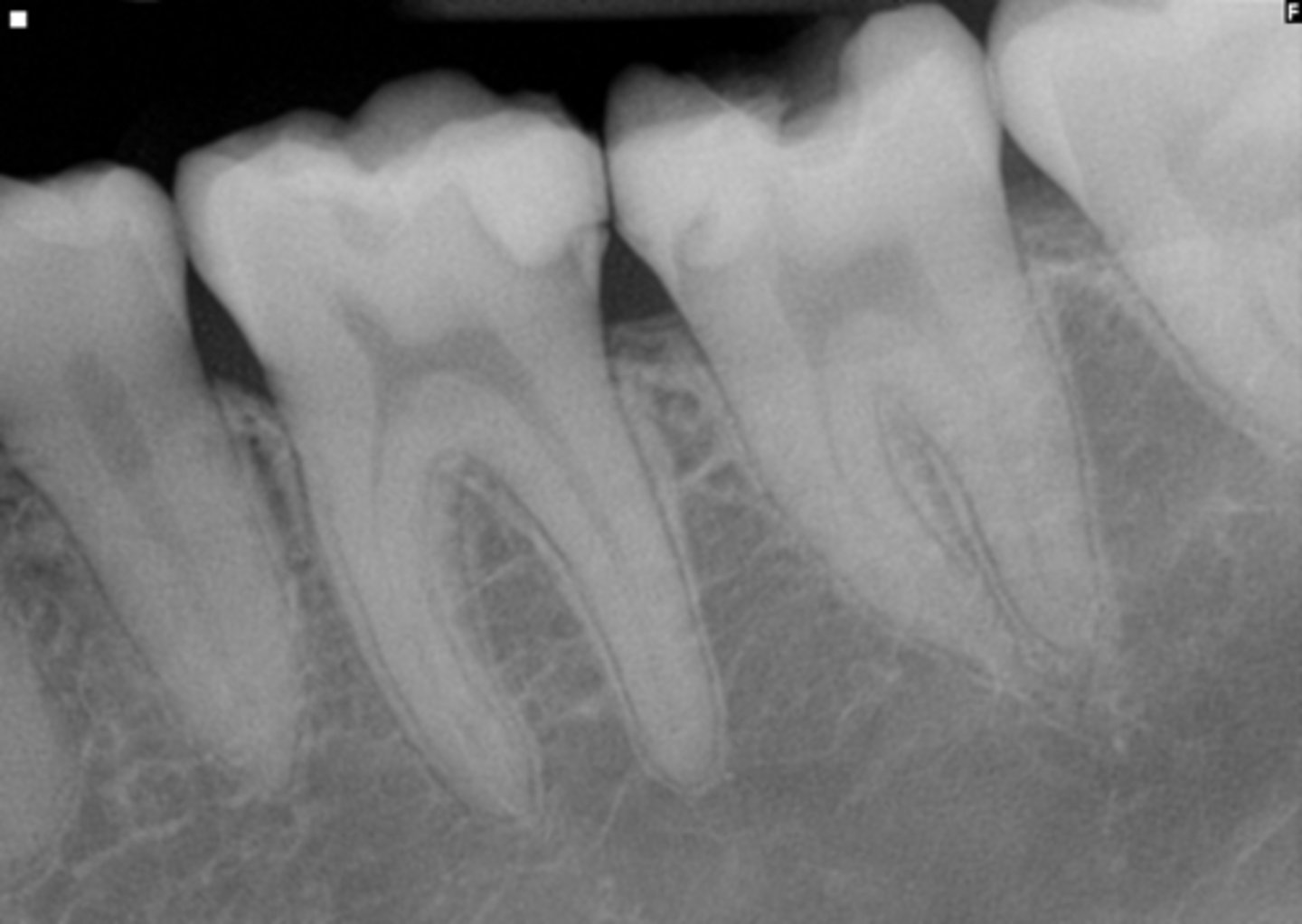 <p>ID the pulpal diagnosis:</p><p>- CC: "My tooth hurts randomly, I can't even touch it"</p><p>- Cold test: Hypersensitive lingering (30 sec or more)</p><p>- Radiograph shows very deep caries into the pulp chamber</p>