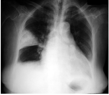 <p>Pulmonary infarct</p>