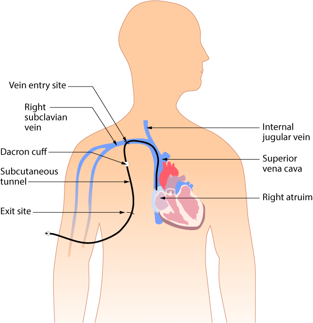 <p>Who typically uses tunneled catheters?</p>