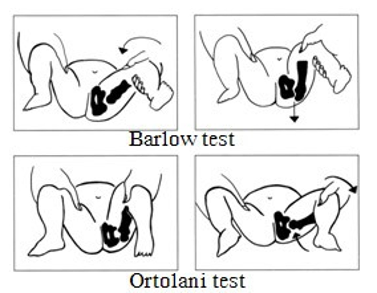 <p>The examiner grasps the infant's thigh near the hip and with gentleposterior/lateral pressure, attempts to dislocate the femoral head fromthe acetabulum. Normally, there is no motion in this direction. If the hipis dislocatable, a distinct "clunk" may be felt as the femoral heads popsout of joint.</p>
