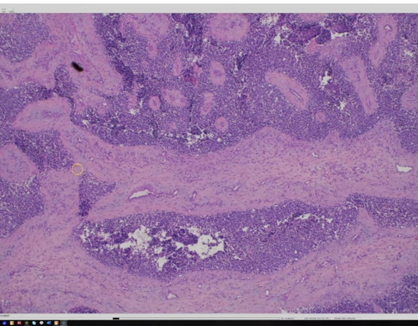 <p>1) diagnostic</p><p>2) histology</p><p>3) dd</p><p>4)clinique (population)</p><p>5) IHC</p><p>6) moléculaire</p>