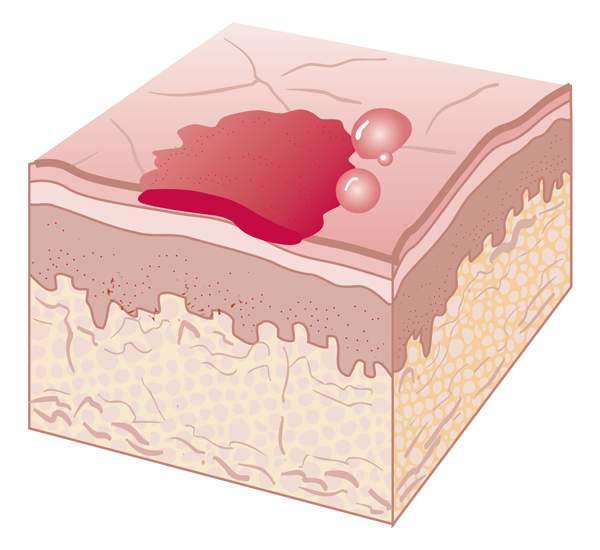 <p>crust is dried exudate (leaked fluid from blood vessels) on the skin</p>