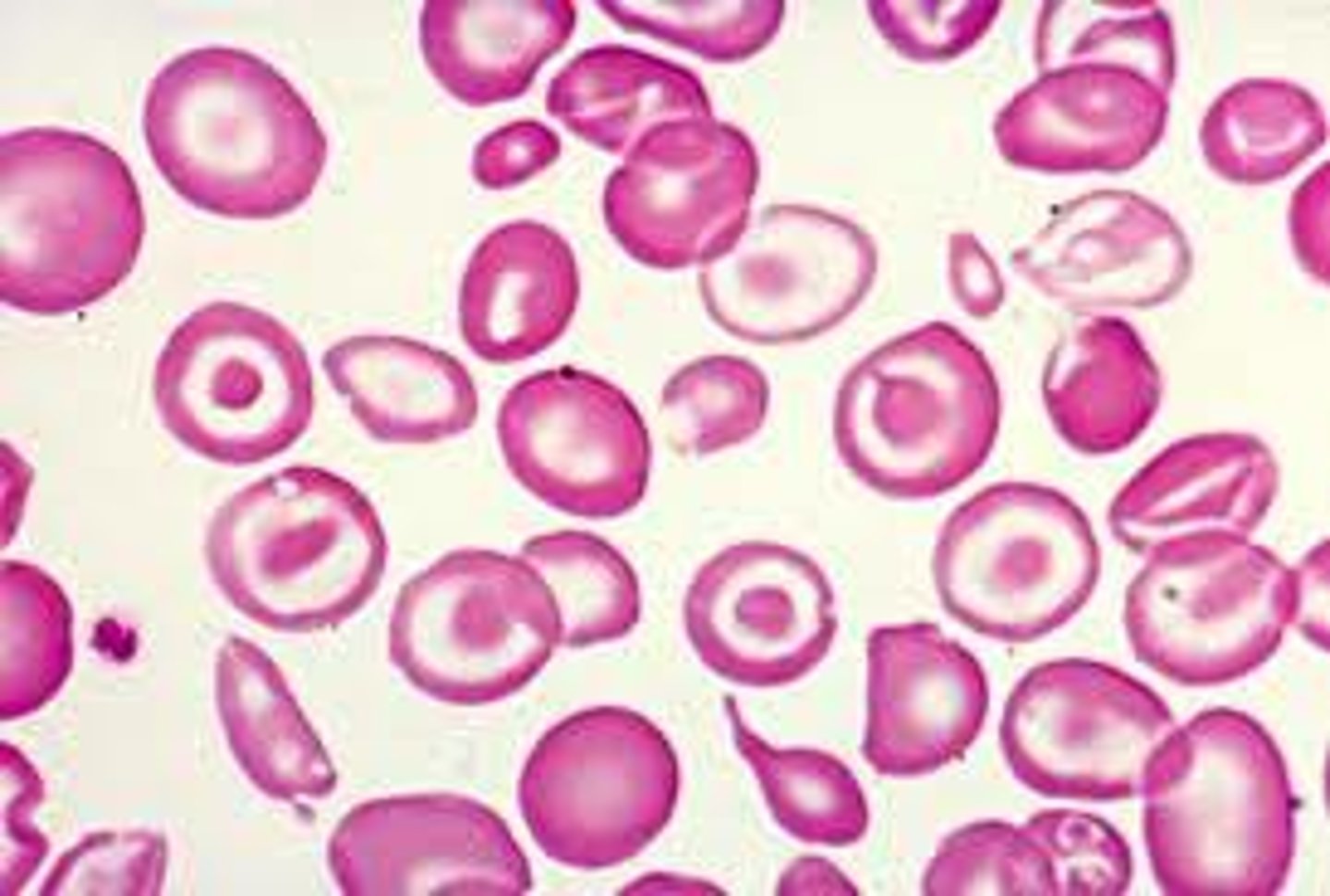 <p>inherited blood disorder with decreased HGB</p>