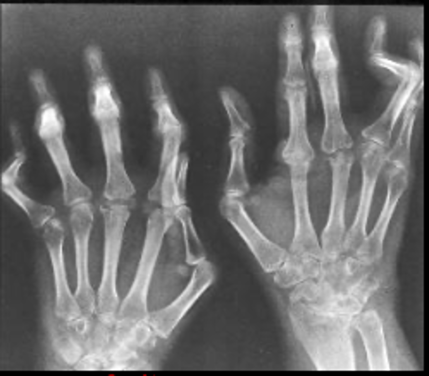 <p>flexion contracture of a PIP joint, extension of a DIP joint, characteristic of rheumatoid arthritis</p>