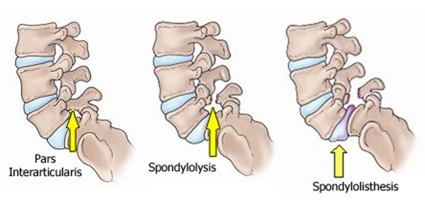 <p>spondylolysis</p><p>bilateral = spondylolisthesis</p>