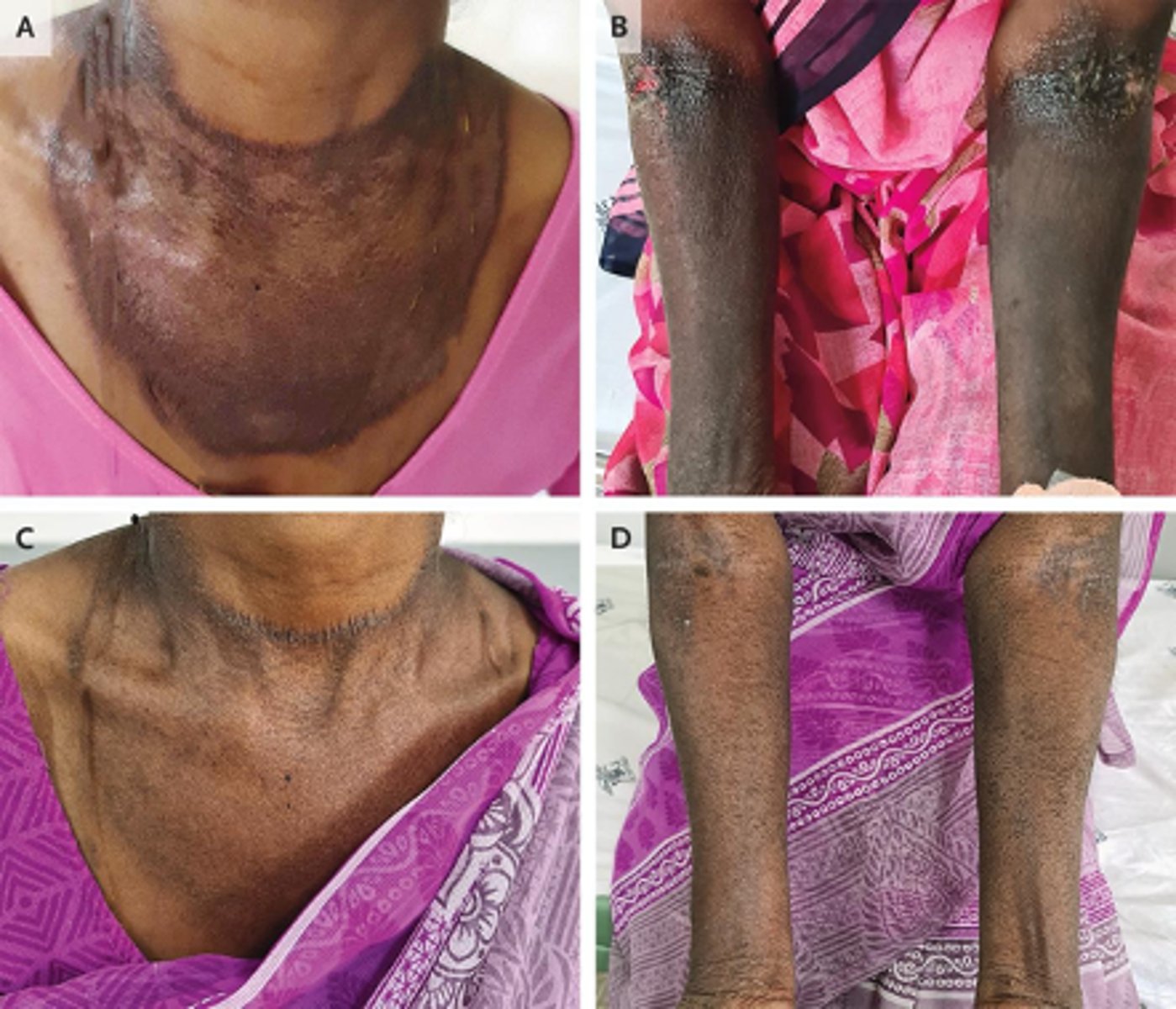 <p>deficiency in this vitamin is associated with pellagra, mouth inflammation (glossitis, angular stomatitis, cheilitis) and the 3 Ds:</p><p>•Dermatitis</p><p>•Diarrhea</p><p>•Dementia</p>
