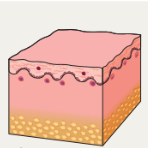 Inflammatory infiltrate of ACLE