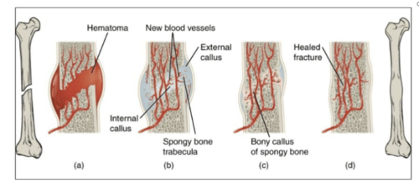 <p>1. A hematoma forms.</p><p>2. Internal and external callus of cartilage forms</p><p>3. Cartilage of the callus is replaced by trabecular bone.</p><p>4. Remodeling occurs.</p>