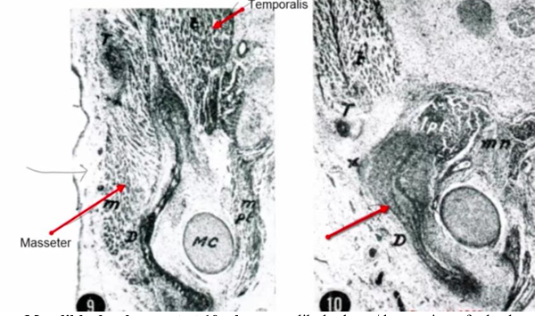 <p>-mandible extends forward as far as the mandibular symphysis and surrounds the anterior portion of Meckel’s cartilage (anterior to mental foramen) almost completely</p><p>-posteriorly, mandibular bone extends into ramus area</p><p>-temporalis and masseter muscle suggest you’re in area of developing coronoid process</p><p>-dentary (body of mandible) formed by intramembranous ossification</p>
