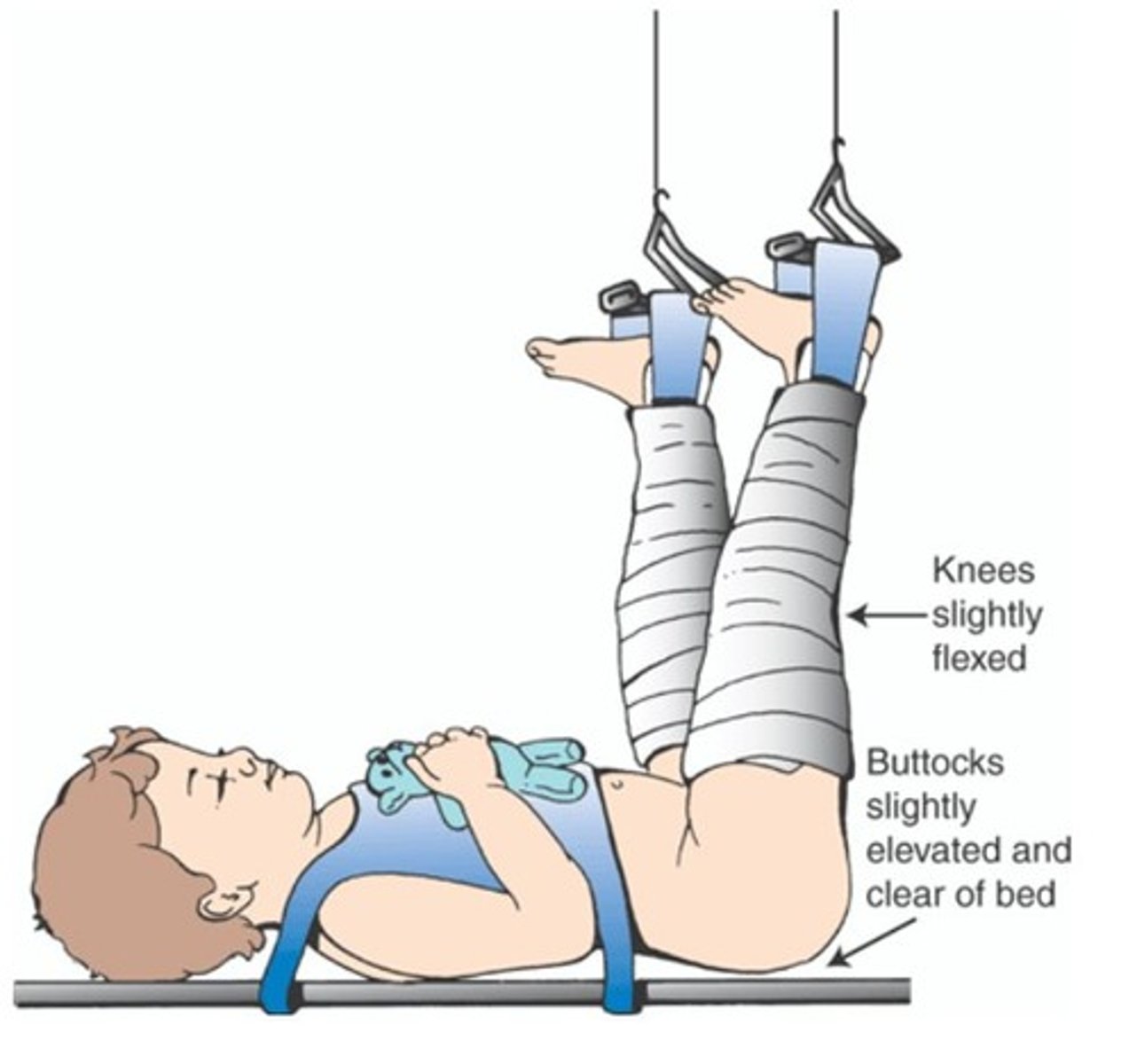 <p>treat adduction contracture → stretches the associated soft tissue</p>
