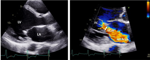 <p>mild : .3cm</p><p>severe : &gt;/= .7cm</p><p>between .3 and .7 needs further evaluation (semi quant)</p>