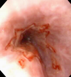 <p><span style="background-color: transparent;"><strong><span>Esophagitis</span></strong></span></p>