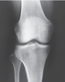 <p>What Knee projections is this </p>