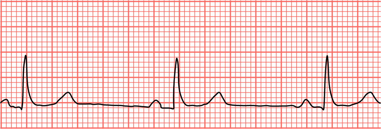 <p>HR:&lt;60 bpm</p><p>P-wave:1 per QRS complex</p><p>Regularity:regular</p><p>PR Interval:Normal</p><p>QRS Duration: Normal</p><p></p>
