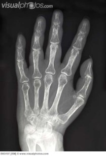 <p>Osteoporosis</p>