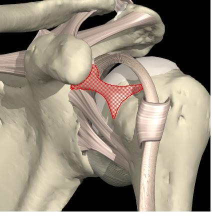 <p>Extends from supraglenoid tubercle of <strong>scapula</strong> to the proximal aspect of the lesser tubercle of <strong>humerus</strong></p><p>along with the coracohumeral ligament, it supports the rotator cuff and prevents inferior translation (downward movement) of the humeral head, especially during shoulder adduction</p>