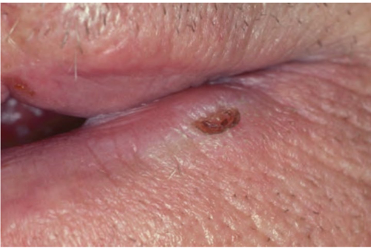 <p>Hint: Usually associated with actinic cheilosis</p>