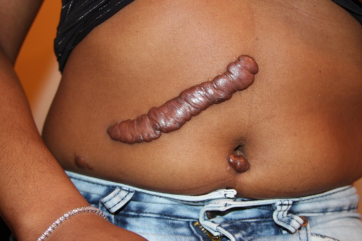 <p>Overgrowth of fibrous tissue forming an enlarged scar</p>