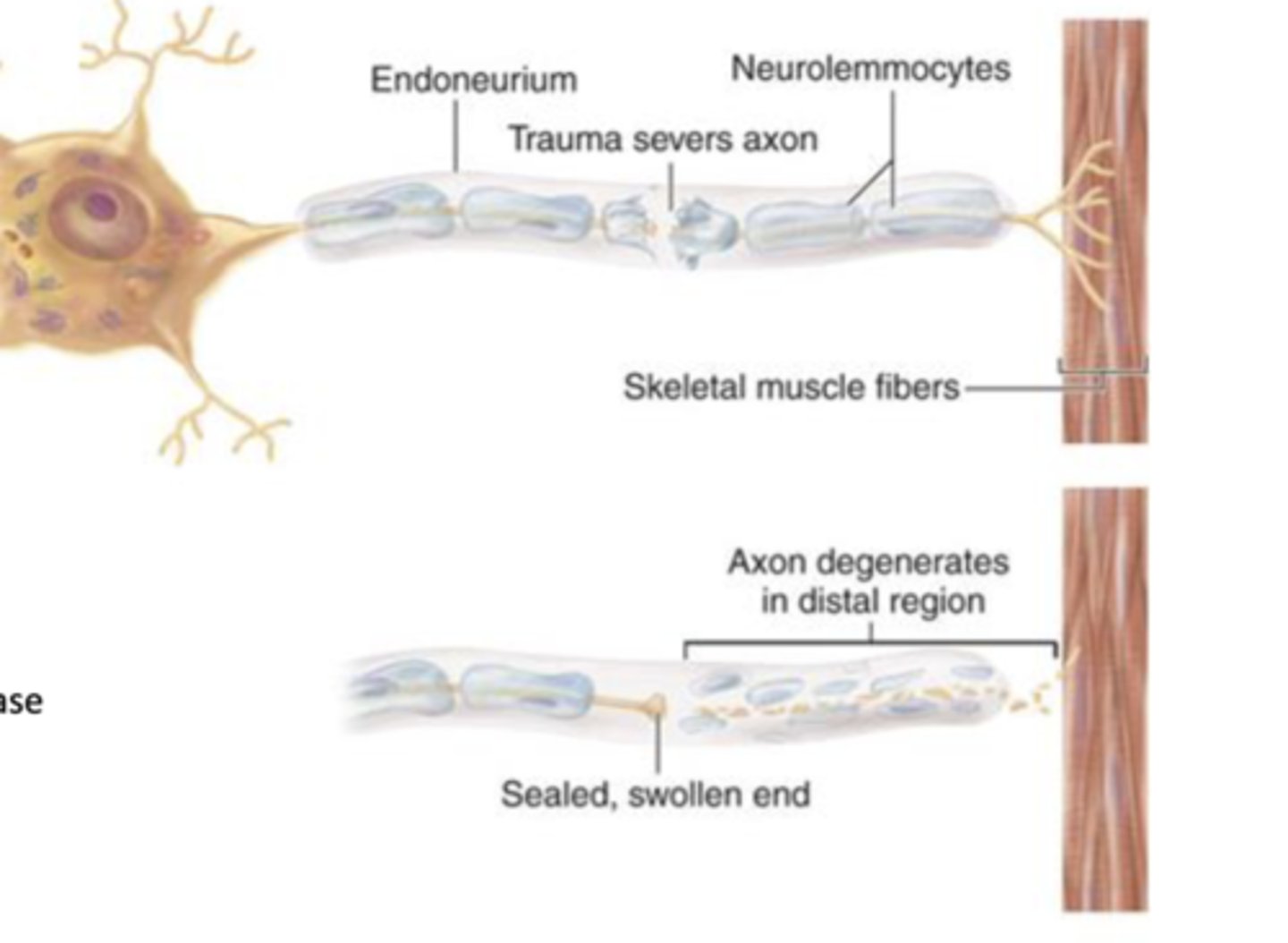 <p>what is step 1 of 4 in peripheral nerve regeneration?</p>