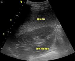 <p>Top - Spleen</p><p>Bottom - Left Kidney</p><p>Place the probe in the 17th intercostal space (or paralumbar fossa) </p><p>Nephrosplenic Window</p>