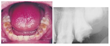 <ul><li><p>a type of enamel dysplasia</p></li><li><p>has a hereditary etiology and can affect all teeth of both dentitions</p></li><li><p>teeth either have no enamel or very thin enamel that chups off, leaving yellow crowns of dentin </p></li></ul><p></p>