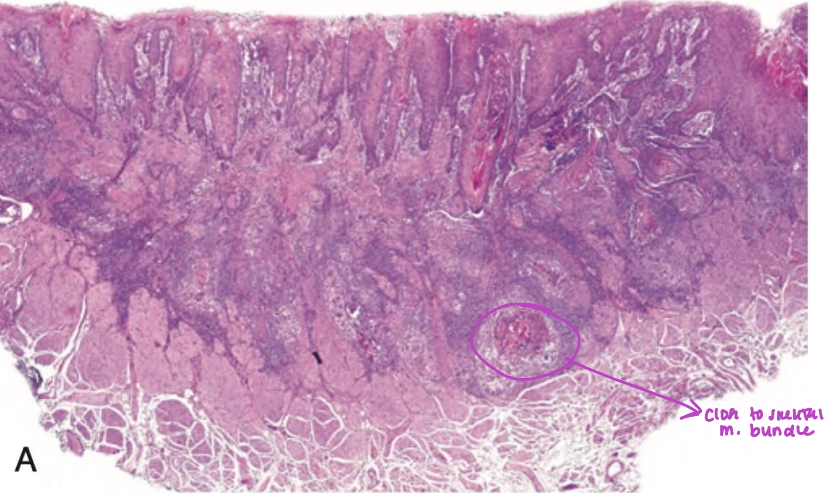 <p>which neoplastic white lesion:</p><p>infiltration to underlying tissue → basement membrane broken</p>