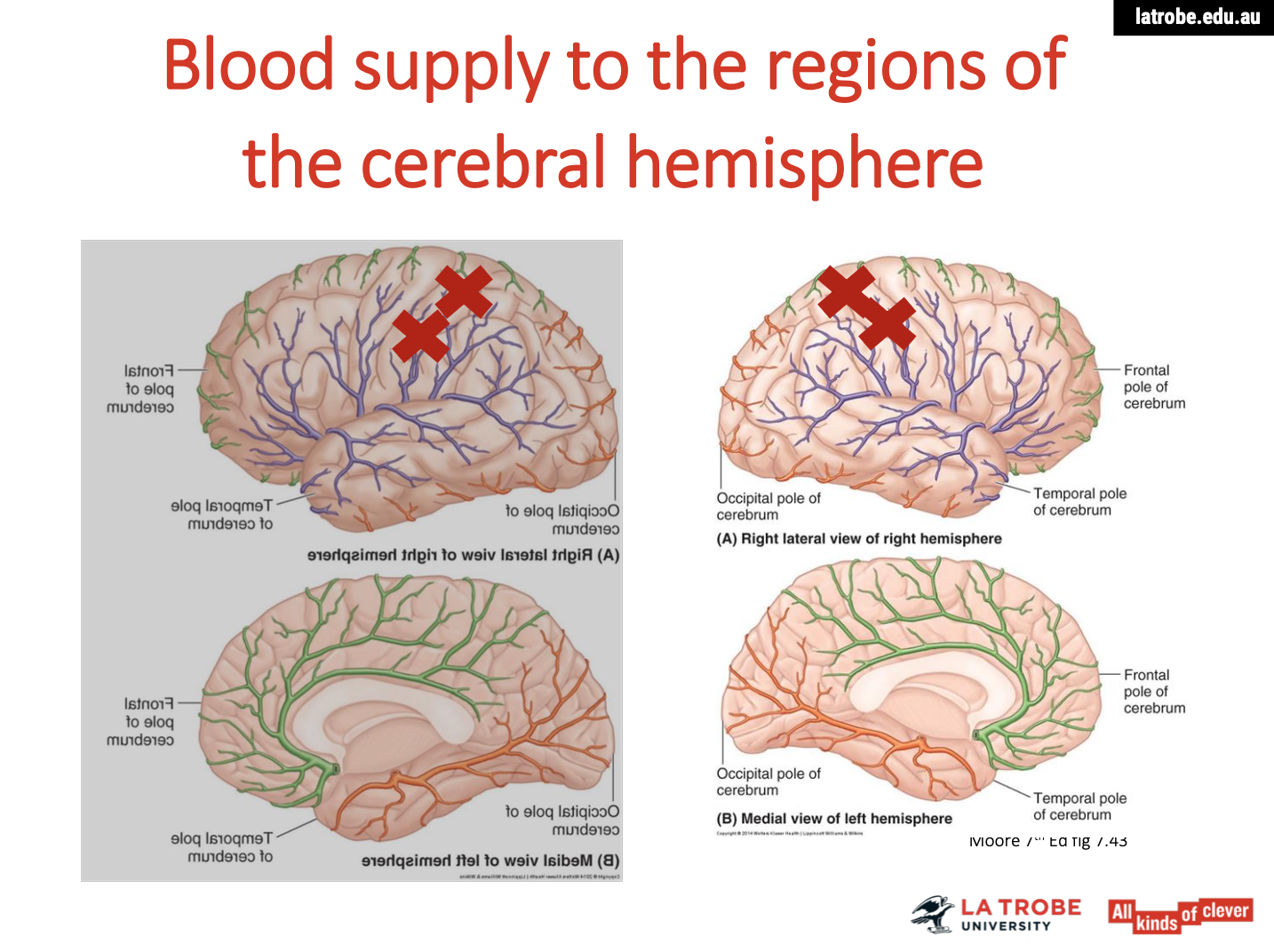<p><span><strong>Consequences of Damage</strong></span></p><ol type="1"><li><p><span><strong>Loss of Sensation:</strong></span></p><ul><li><p><span><strong>Individuals may experience&nbsp;numbness&nbsp;or a&nbsp;loss of sensation&nbsp;in areas of the body corresponding to the damaged part of the postcentral gyrus. This can lead to difficulty feeling touch, pressure, or temperature changes.</strong></span></p></li></ul></li><li><p><span><strong>Altered Sensory Perception:</strong></span></p><ul><li><p><span><strong>Damage can result in&nbsp;paresthesia, where individuals may experience tingling or prickling sensations in certain body areas. They might also misinterpret sensory inputs (e.g., feeling pain when there is none).</strong></span></p></li></ul></li><li><p><span><strong>Difficulty with Proprioception:</strong></span></p><ul><li><p><span><strong>Individuals may struggle with&nbsp;proprioception, affecting their ability to sense the position and movement of their limbs. This can lead to difficulties in coordination and balance.</strong></span></p></li></ul></li><li><p><span><strong>Tactile Agnosia:</strong></span></p><ul><li><p><span><strong>Known as&nbsp;astereognosis, individuals may be unable to recognize objects by touch alone. They might not be able to identify familiar objects placed in their hands without visual input.</strong></span></p></li></ul></li><li><p><span><strong>Spatial Awareness Issues:</strong></span></p><ul><li><p><span><strong>Damage to the postcentral gyrus can affect&nbsp;spatial awareness, making it difficult for individuals to perceive their body in relation to their surroundings. This can impact their ability to navigate spaces or interact with objects accurately.</strong></span></p></li></ul></li><li><p><span><strong>Impact on Daily Activities:</strong></span></p><ul><li><p><span><strong>The sensory deficits can hinder daily tasks such as dressing, cooking, and other activities that require fine motor skills or sensory feedback from the environment</strong></span></p></li></ul></li></ol><p></p>