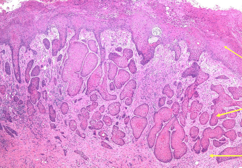 <p>In which two conditions do you see Pseudoepithelial Hyperplasia (PEH)?</p>