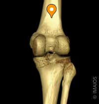 <p><span style="color: blue"><strong>b. Diện khoeo </strong></span><span style="color: red"><strong>(popliteal surface)</strong></span></p>