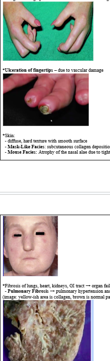 <p><span style="background-color: transparent; font-family: "Times New Roman", serif;"><strong>*Raynaud Phenomenon:</strong></span></p><p><span style="background-color: transparent; font-family: "Times New Roman", serif;">  - often 1<sup>st</sup> sign</span></p><p><span style="background-color: transparent; font-family: "Times New Roman", serif;">  - vasoconstriction in fingers, toes, ears, nose triggered by emotional distress or exposure to cold</span></p><p><span style="background-color: transparent; font-family: "Times New Roman", serif;">  - skin becomes white → blue and numb → red and throbbing</span></p><p><span style="background-color: transparent; font-family: "Times New Roman", serif;">  - can occur in healthy people </span></p><p><span style="background-color: transparent; font-family: "Times New Roman", serif;"><strong>*Acro-osteolysis:</strong></span></p><p><span style="background-color: transparent; font-family: "Times New Roman", serif;">  - resorption of terminal phalanges and flexion contractures (shortening of muscle tissue) → shorted fingers</span></p><p><span style="background-color: transparent; font-family: "Times New Roman", serif;">  - due to microvascular occlusion</span></p><p><span style="background-color: transparent; font-family: "Times New Roman", serif;"><strong>*Sclerodactyly:</strong></span></p><p><span style="background-color: transparent; font-family: "Times New Roman", serif;">  - due to abnormal collagen deposition → fingers become stiff, skin becomes tense/shiny</span></p><p><span style="background-color: transparent; font-family: "Times New Roman", serif;">  - fingers undergo permanent flexure → claw-like fingers</span></p><p><span style="background-color: transparent; font-family: "Times New Roman", serif;">*<strong>Ulceration of fingertips</strong> – due to vascular damage</span></p><p><span style="background-color: transparent; font-family: "Times New Roman", serif;">*Skin:</span></p><p><span style="background-color: transparent; font-family: "Times New Roman", serif;">  - diffuse, hard texture with smooth surface</span></p><p><span style="background-color: transparent; font-family: "Times New Roman", serif;">  - <strong>Mask-Like Facies</strong>: subcutaneous collagen deposition in facial skin → smooth, taut face</span></p><p><span style="background-color: transparent; font-family: "Times New Roman", serif;">  - <strong>Mouse Facies:</strong> Atrophy of the nasal alae due to tightening of the skin → pinched nose</span></p><p><span style="background-color: transparent; font-family: "Times New Roman", serif;">*Fibrosis of lungs, heart, kidneys, GI tract → organ failure</span></p><p><span style="background-color: transparent; font-family: "Times New Roman", serif;">  - <strong>Pulmonary Fibrosis</strong> → pulmonary hypertension and heart failure, primary cause of death (image: yellow-ish area is collagen, brown is normal parenchyma)</span></p>