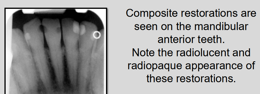<ul><li><p>Appearance can vary on radiographs from radiolucent to slightly radiopaque </p></li><li><p>density depends on the composition of the composite material </p></li></ul><p></p>