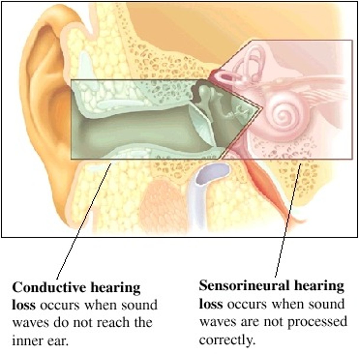 <p>hearing loss caused by damage to the mechanical system that conducts sound waves to the cochleaConduction deafness</p>