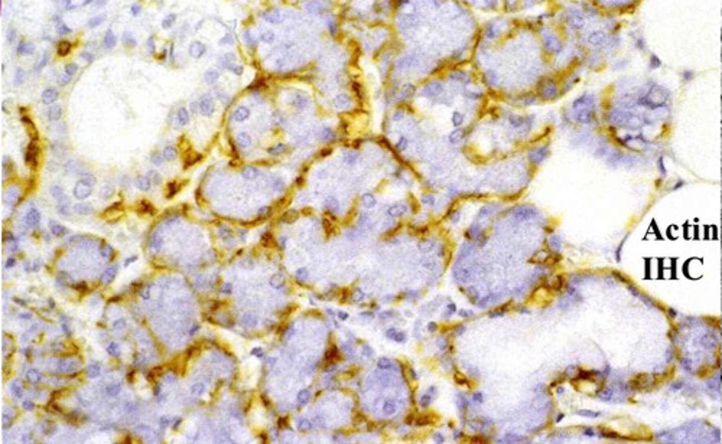 <p>myoepithelial cells seen with Actin IHC staining</p>
