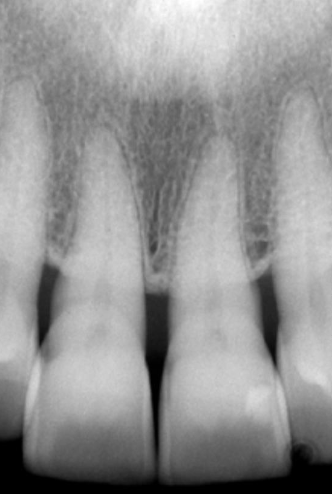<ul><li><p>Signs of successful treatment are occasionally visible</p><ul><li><p>Not universally seen</p></li><li><p>No apparent changes in many cases</p></li></ul></li><li><p>Good indicators of disease stabilization</p><ul><li><p>Reestablishment of interproximal crestal cortex</p></li><li><p>Reestablishment of sharp angle between cortex and lamina dura</p></li></ul></li><li><p>Other possible indicators of successful treatment</p><ul><li><p>Sclerosis of previously radiolucent margins of defect</p></li><li><p>Remineralization of previously radiolucent bone</p></li></ul></li><li><p>X-ray beam angulation and exposure settings may affect crest visibility</p><ul><li><p>Too high exposure – black image; thin bone may not be apparent, giving impression bone is resorbed</p></li><li><p>Too low exposed – light image; giving impression of bone growth</p></li></ul></li><li><p>Treatment success and healing best assessed clinically</p></li></ul><p></p>