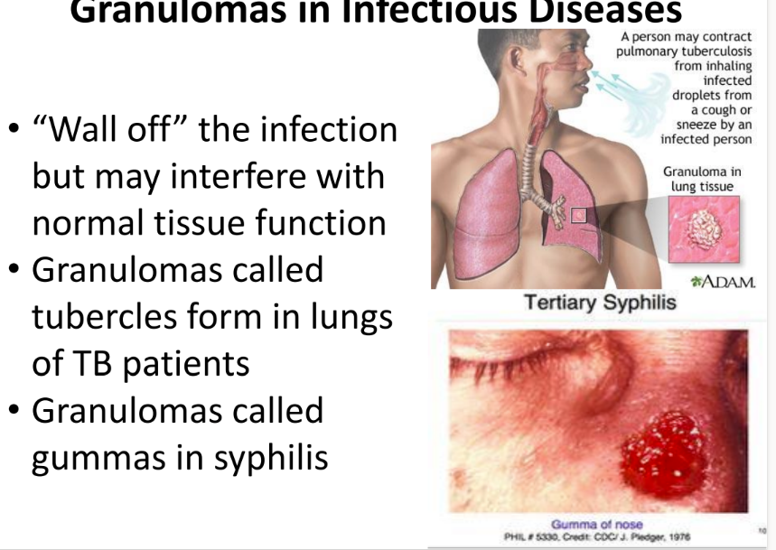 <p>tubercles = lungs of TB pts </p><p>gummas = syphilis </p>