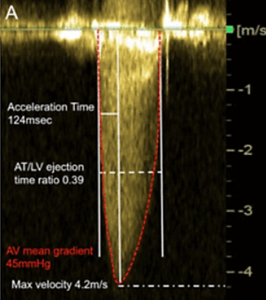 <p>Time from onset of flow to peak velocity</p>