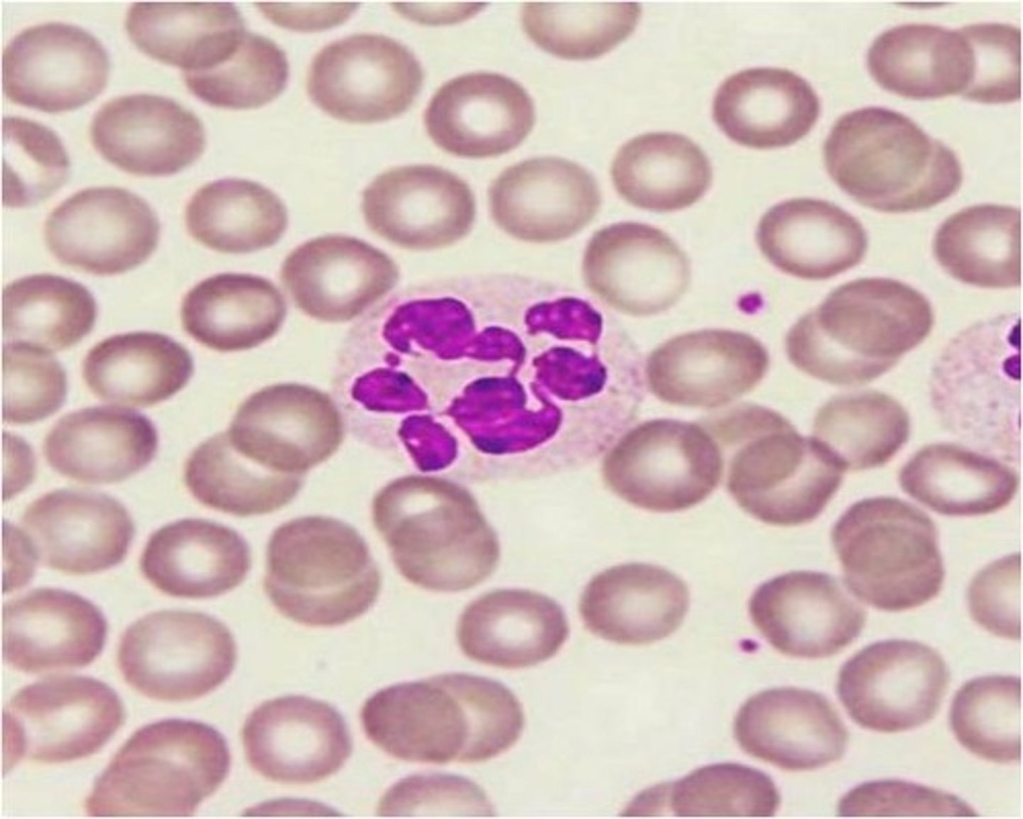 <p>in megaloblastic anemia, these cells have six or more lobes, and tapering chromatin strands</p>