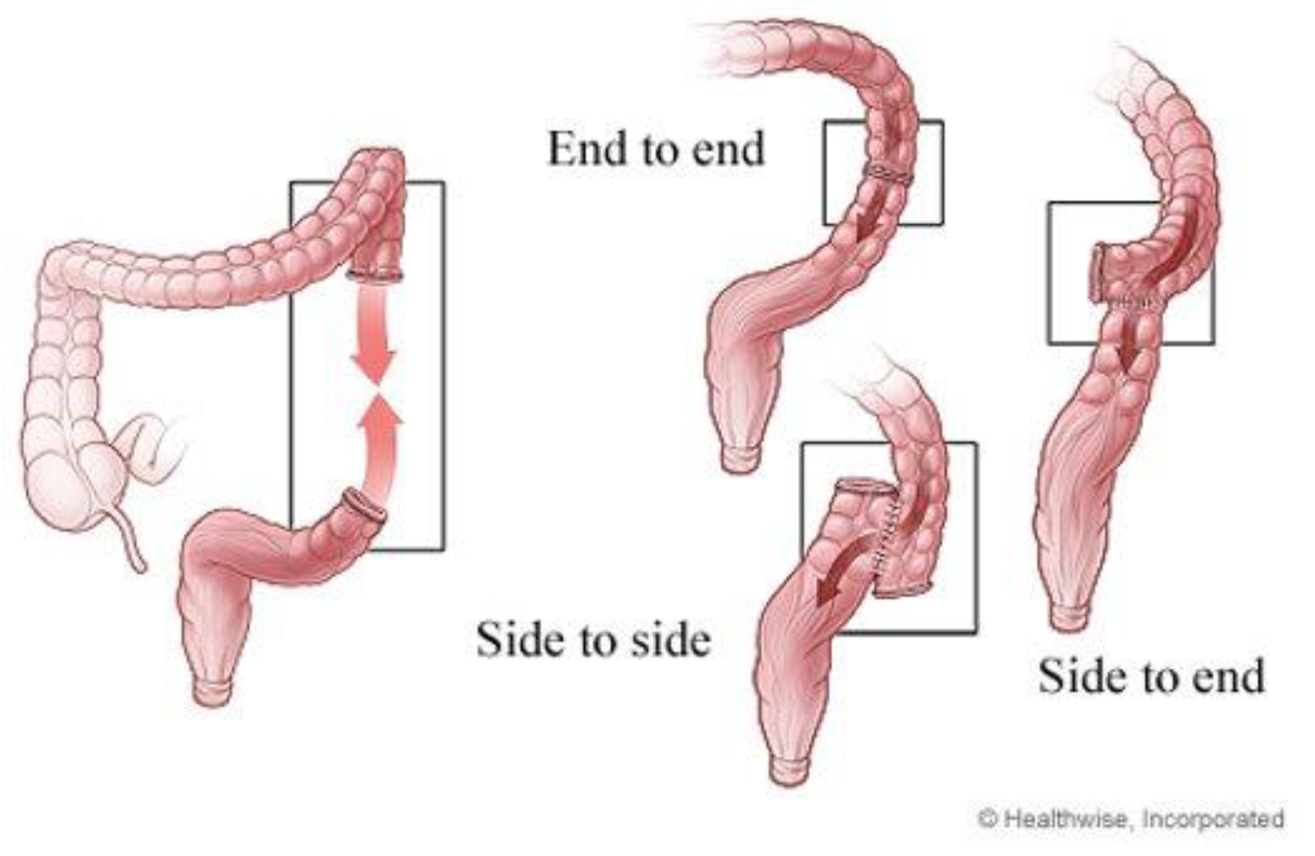 <p>anastomosis</p>