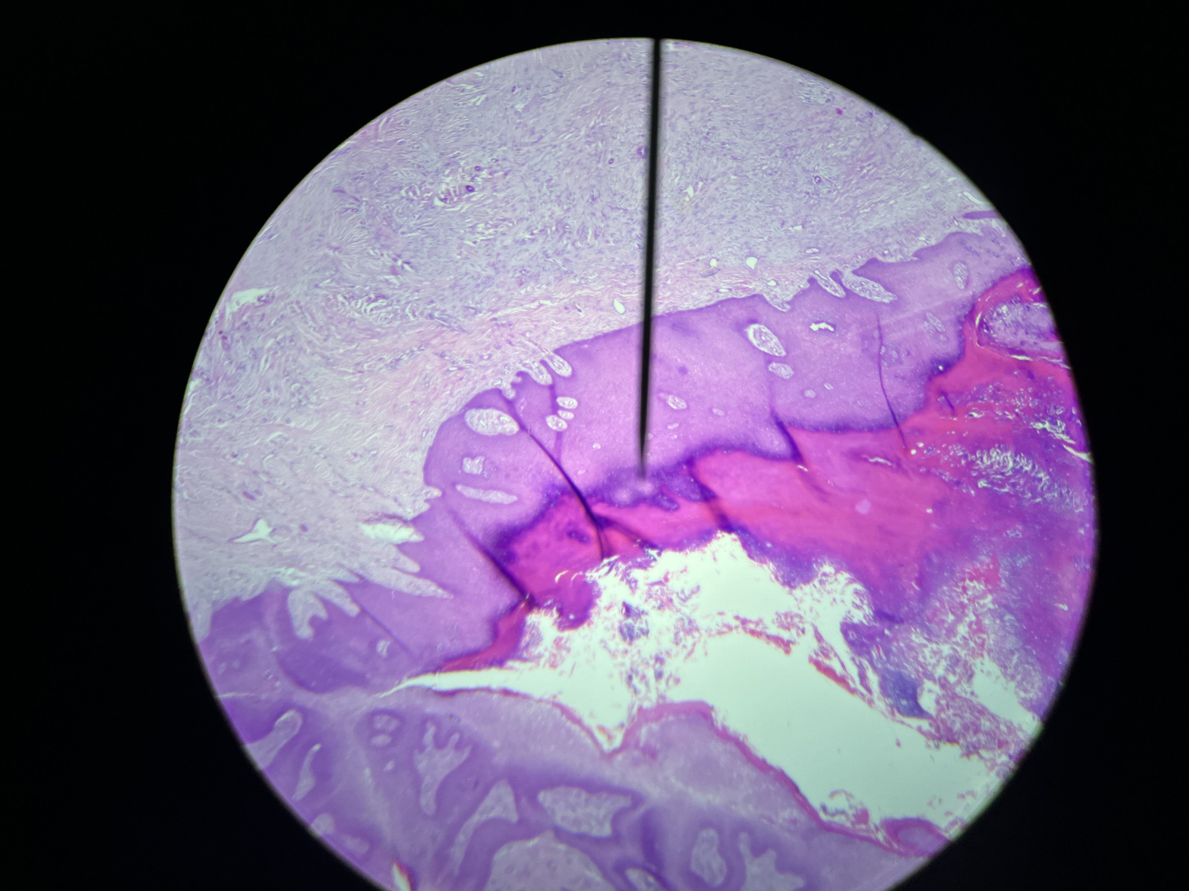<p>A contagious viral infection that causes benign, raised lesions on the skin, primarily affecting children and sexually active adults. </p>
