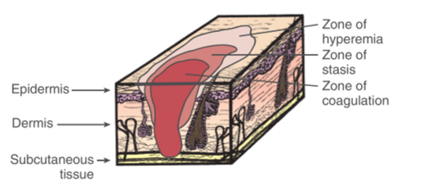 <p>The area of the burn that received the most severe injury with irreversible cell damage</p>
